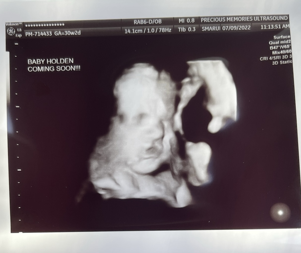 3d ultrasound of baby boy's face