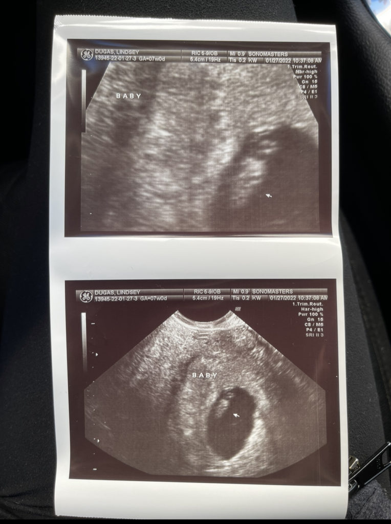 ultrasound photos of baby